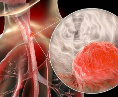 Cách phòng ngừa ung thư thực quản